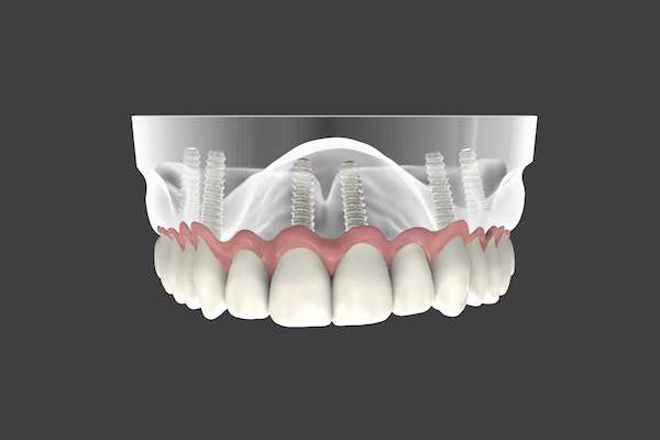 Are Implant Supported Dentures Permanent from The Dental Place Of Oakland Park in Oakland Park, FL