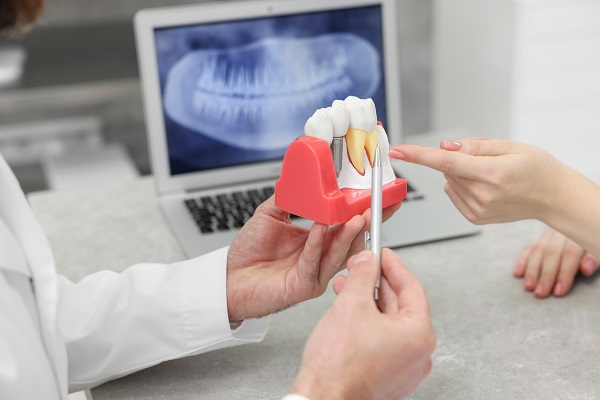 Securely Replace Missing Teeth With Dental Implants