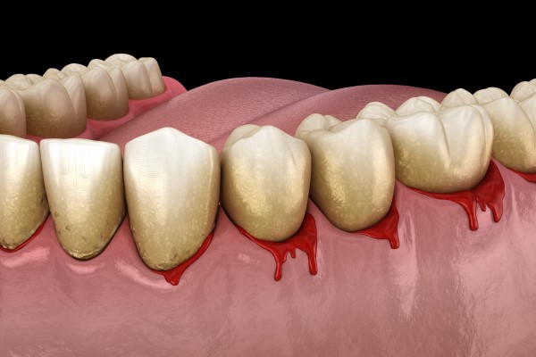 Are Bleeding Gums A Sign Of Gum Disease?