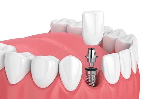 How Painful is Dental Implant Surgery from The Dental Place Of Oakland Park in Oakland Park, FL