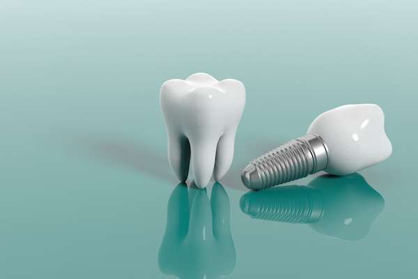 Multiple Teeth Replacement Options: One Implant for Two Teeth from The Dental Place Of Oakland Park in Oakland Park, FL