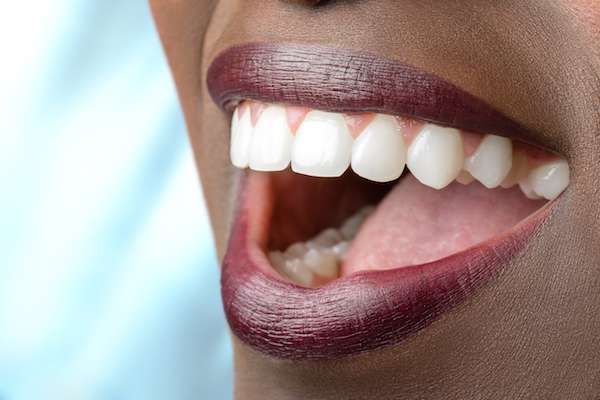 Routine Dental Care: What Are Tooth Colored Fillings from The Dental Place Of Oakland Park in Oakland Park, FL