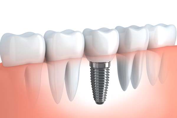 Your Ultimate Guide to Getting Dental Implants from The Dental Place Of Oakland Park in Oakland Park, FL